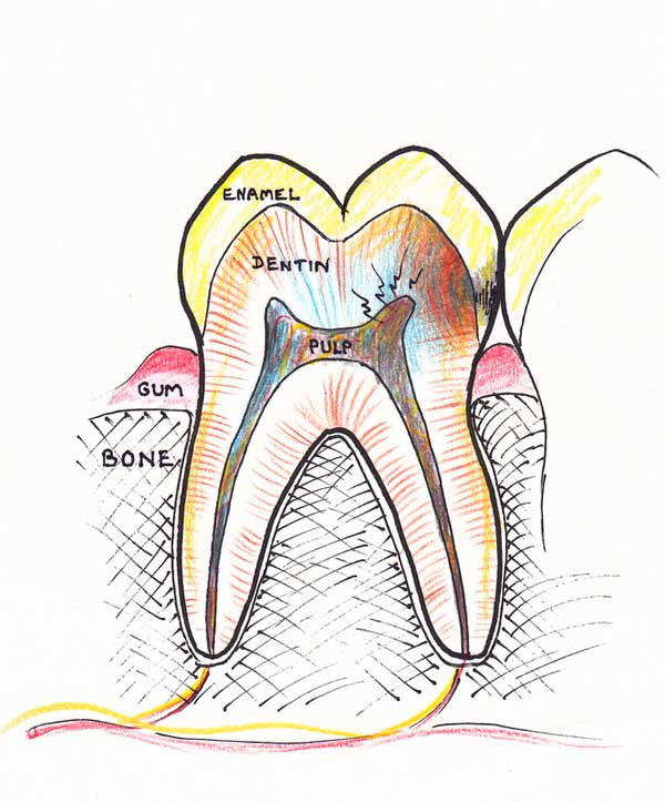 Treating a root canal infection - stage 1