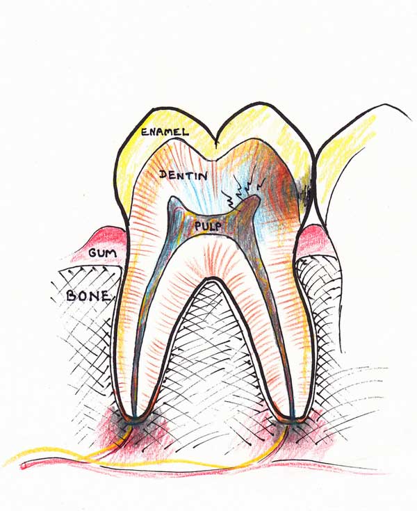 Treating a root canal infection - stage 2