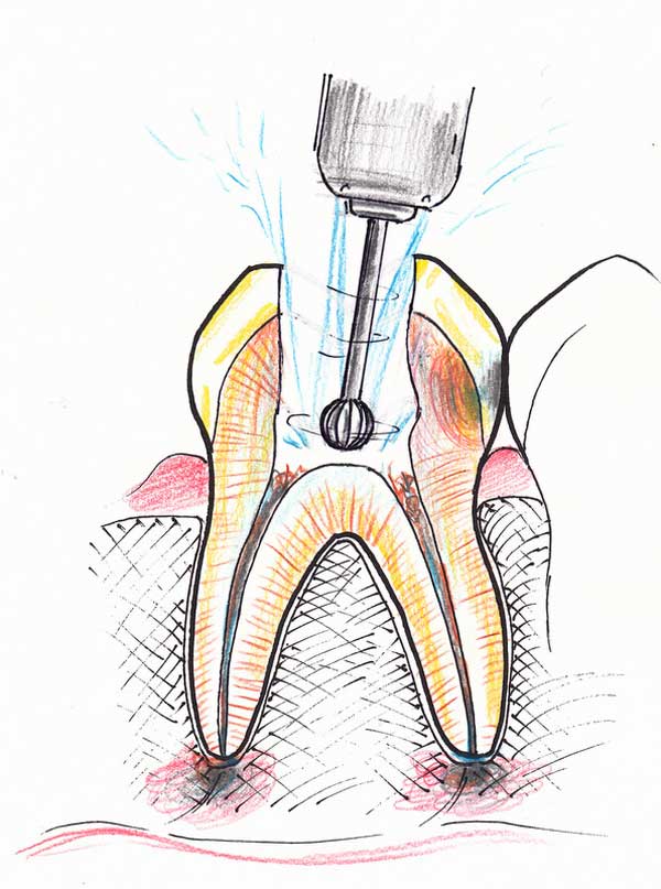 Treating a root canal infection - stage 3