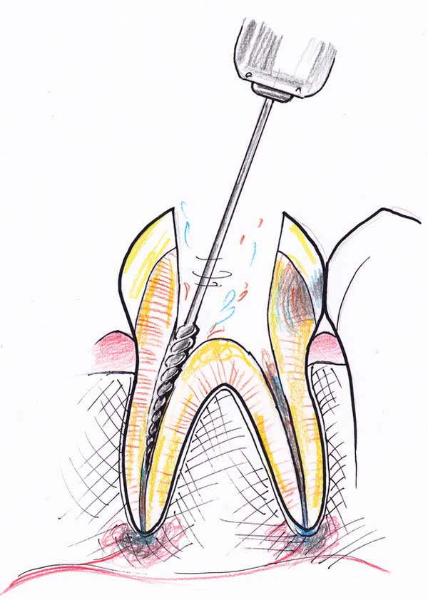 Treating a root canal infection - stage 4