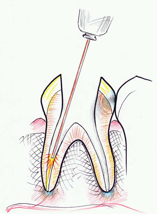 Treating a root canal infection - stage 5
