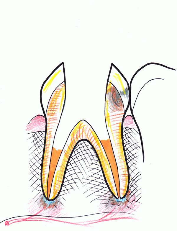 Treating a root canal infection - stage 6