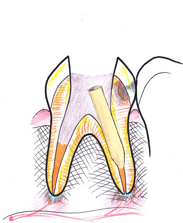Treating a root canal infection - stage 7
