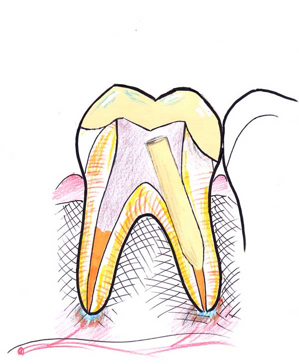 Treating a root canal infection - stage 9
