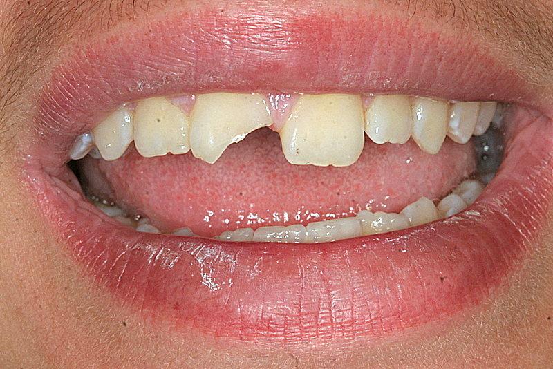 Boy with chipped front tooth