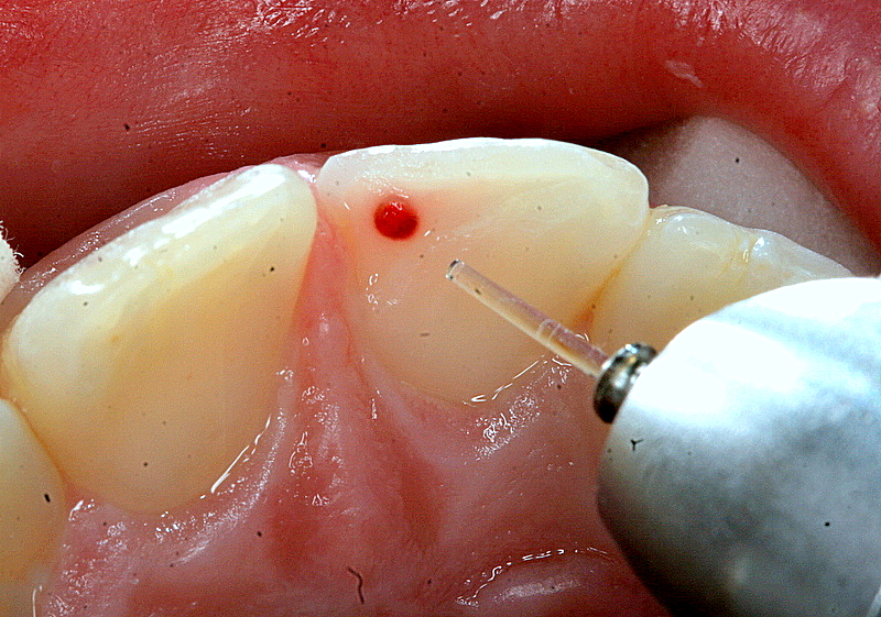 Disinfecting chipped tooth with laser