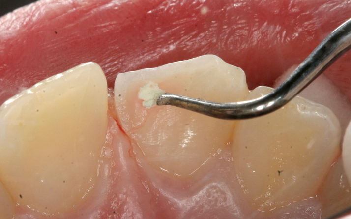 Dressing chipped tooth with MTA
