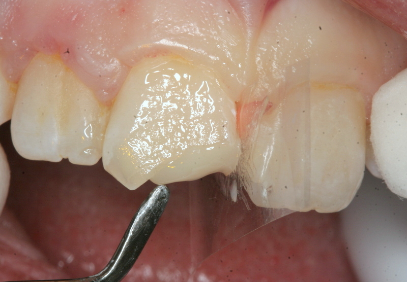 Build up chipped tooth