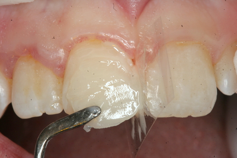 aesthetic bonding of chipped tooth