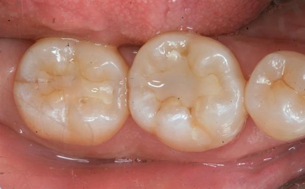poorly bonded tooth
