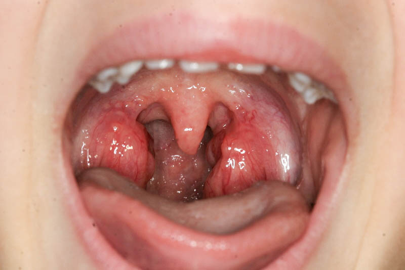 tonsills Deep throat