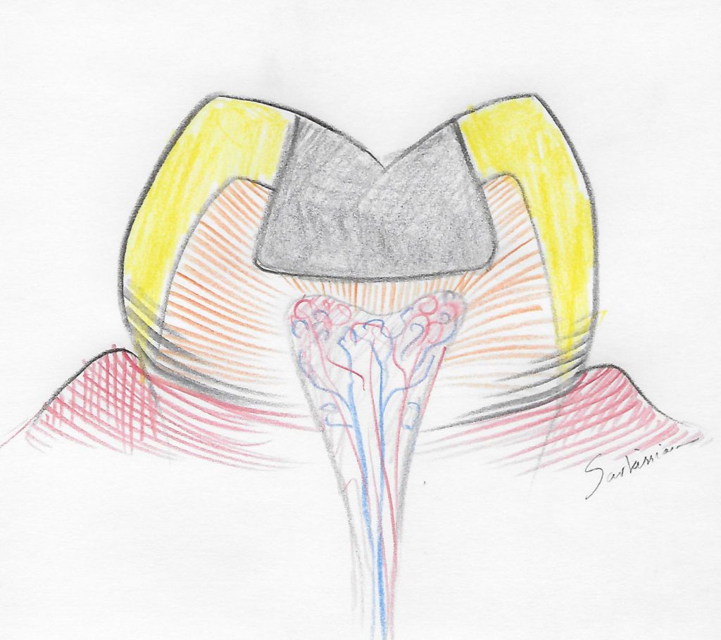 illustration of a tooth with amalgam filling