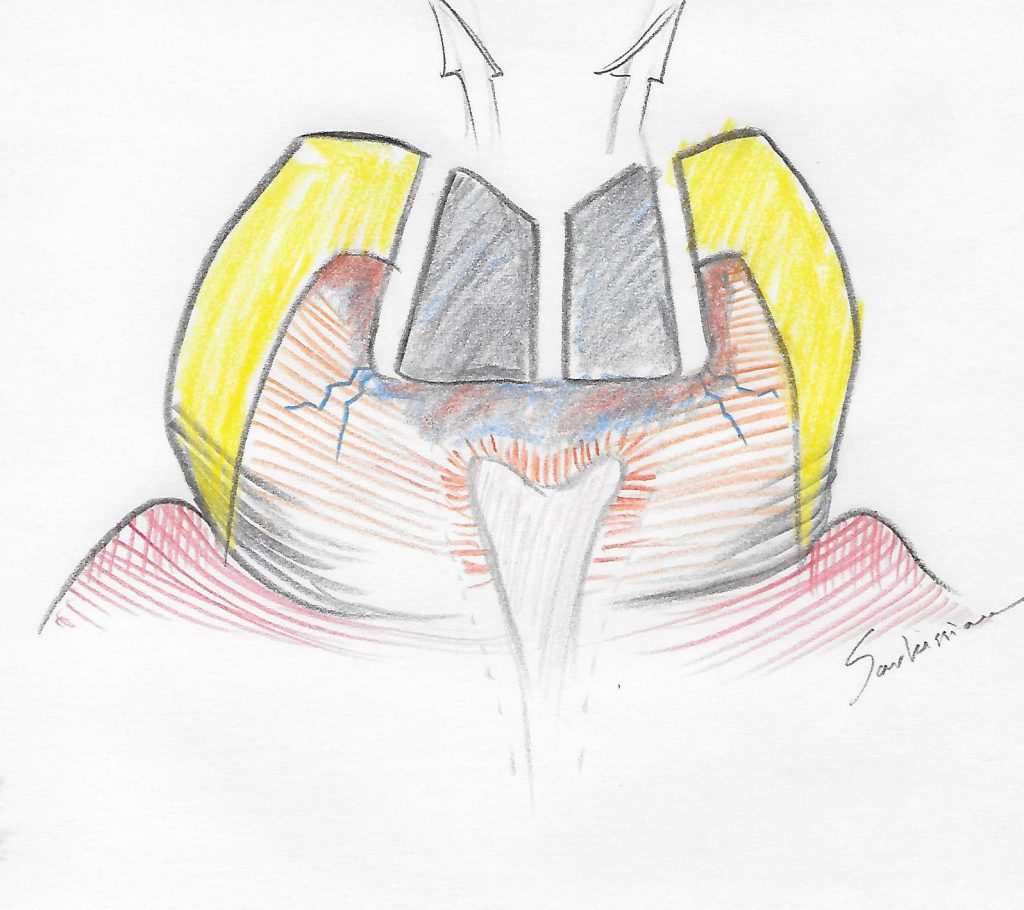 illustration of safe amalgam removal