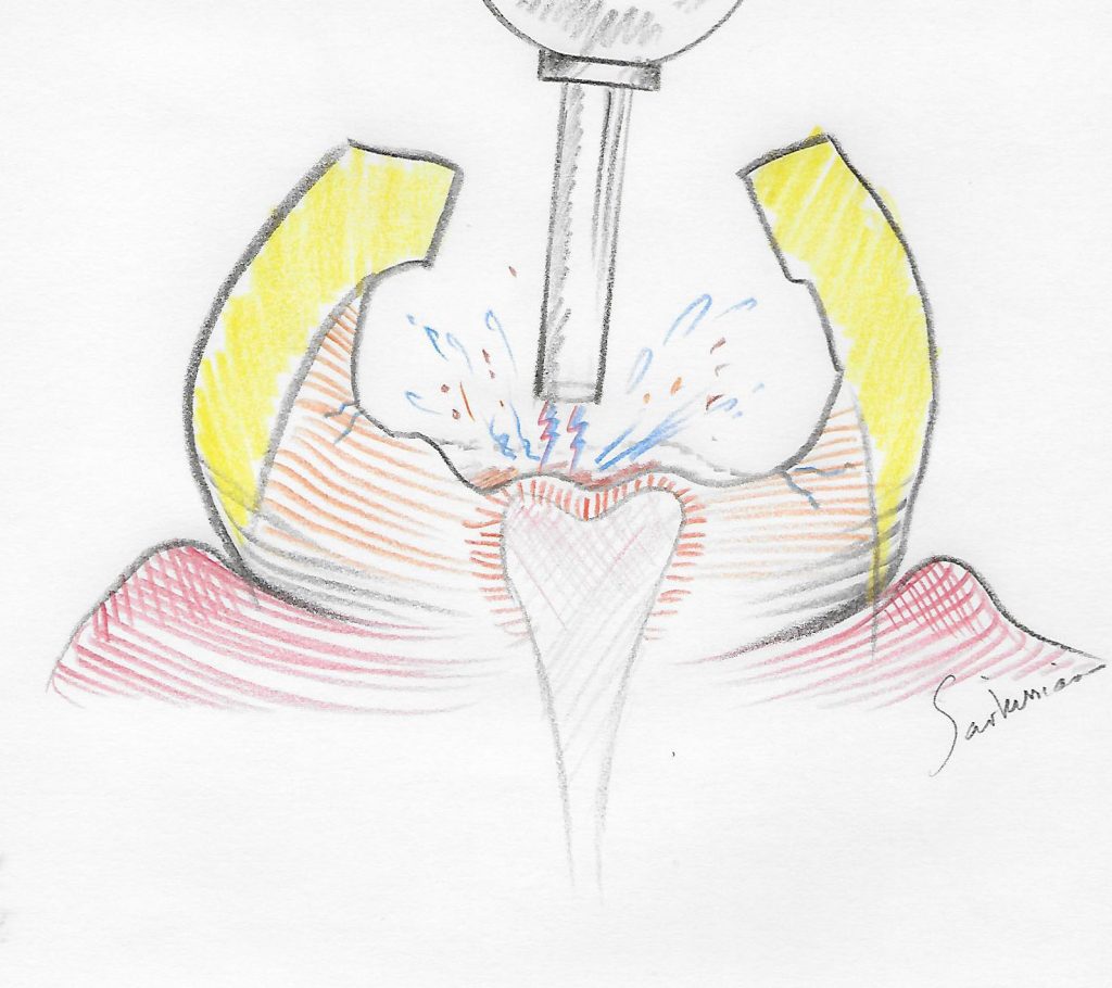 illustration of deep tooth decay emoval with the laser