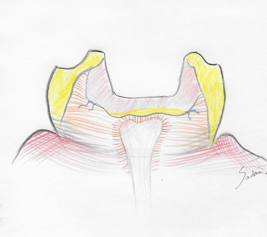 illustration of the onlay design after removal of tooth decay
